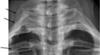 cervical rib
