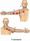 Tingling right hand with ache in arm, arm pit and front ...