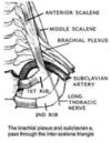 In TOS, both the artery and the brachial plexus of nerves are affected. 