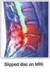 Prolapsed disc