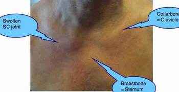 Tietzes syndrome costochondritis