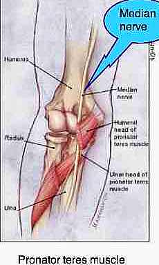 Pronator teres affecting median nerve