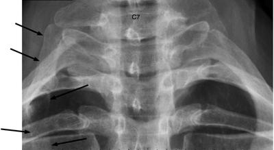 cervical rib