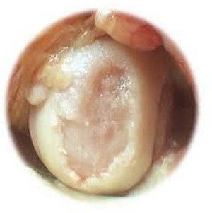 Torn Cartilage on back of Patella Tendon