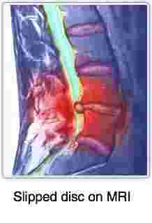 Prolapsed disc