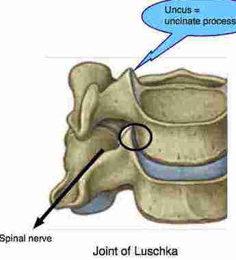 uncovertebral arthrosis)