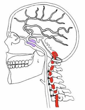 The vertebral artery may be injured and dissect after whiplash. The vertebral artery may be injured and dissect after whiplash.