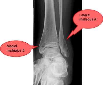 Ankle fracture is in the first instance a job for a surgeon.