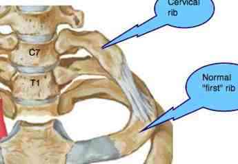 cervical ribs are an uncommon anomaly causing pain tingling in arms