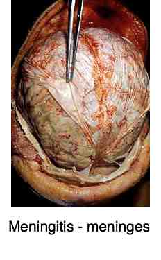 meningitis headache meninges bip beamer epson