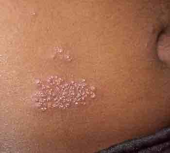 Chiropractic shingles provides complementary thoughts about disease