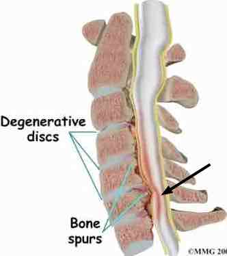 Leg pain and nerve pain in the feet post lumbar surgery