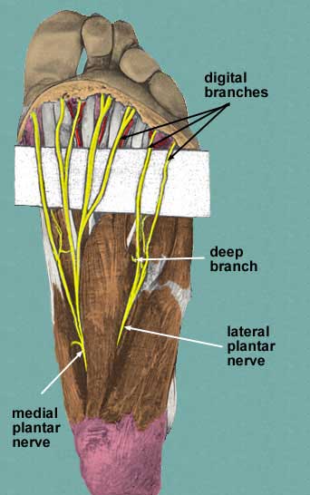 Mortonse neuralgie is een zenuwbeknelling onder de voet.