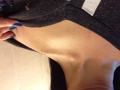 Swollen Sterno Clavicle Joint and upper chest