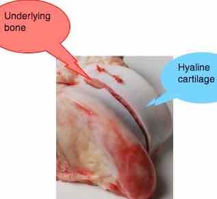 Hyaline cartilage defects